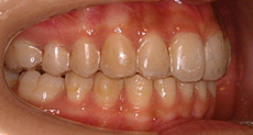 invisalign-img01-1